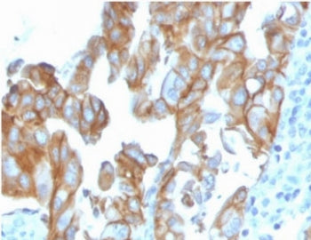IHC staining of FFPE human colon carcinoma with MerTK antibody (clone TPKR-1). HIER: boil tissue sec