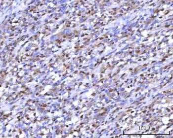 IHC staining of FFPE human intestine diffuse large B-cell lymphoma tissue with mRNA-capping enzyme a