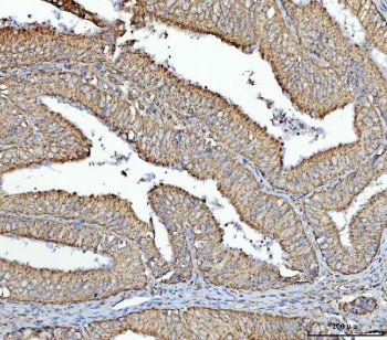 IHC staining of FFPE human endometrial carcinoma tissue with RPS13 antibody. HIER: boil tissue secti