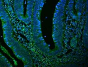 Immunofluorescent staining of FFPE human rectal cancer with FLNA antibody (green) and DAPI nuclear s