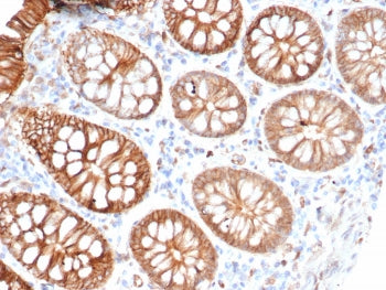 IHC staining of FFPE human colon carcinoma tissue with S100A16 antibody (clone S100A16/7411). HIER: