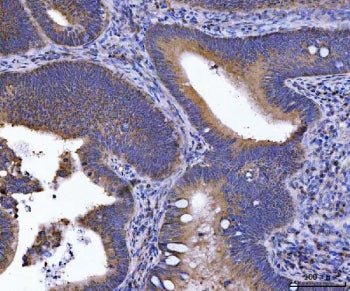 IHC staining of FFPE human rectal cancer tissue with GOLGA3 antibody. HIER: boil tissue sections in