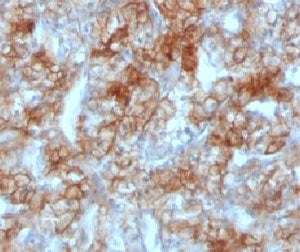 IHC testing of FFPE human renal cell carcinoma and Cadherin 16 antibody (clone KSCP2). Staining of f