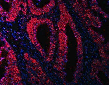 Immunofluorescent staining of FFPE human intestinal cancer with OTT3 antibody (red) and DAPI nuclear