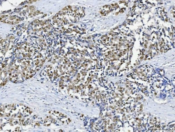 IHC testing of FFPE human gallbladder carcinoma tissue with ABL2 antibody. HEIR: Boil the paraffin s