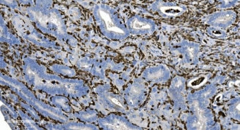 IHC staining of FFPE human gallbladder adenocarcinoma tissue with Coronin 1a antibody. HIER: boil ti