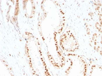 IHC staining of FFPE human prostate carcinoma tissue with p287Kip1 antibody (clone SX53G8). HIER: bo