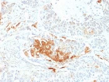 IHC staining of FFPE human neuroendocrine tumor with NSE antibody (clone ENO2/2706). HIER: boil tiss