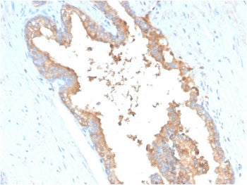 IHC staining of FFPE human prostate carcinoma with Transferrin antibody (clone TF/3001). HIER: boil