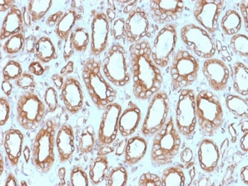 IHC testing of FFPE human renal cell carcinoma with Calnexin antibody (clone CANX/1543). HIER: boil