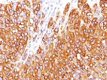 IHC testing of FFPE human melanoma stained with MART-1 antibody (clone M2-7C10). Note cytoplasmic st