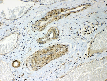 IHC testing of FFPE human lung cancer tissue with HSP22 antibody at 1ug/ml. Required HIER: steam sec