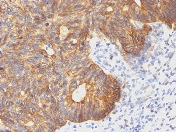 IHC: Formalin-fixed, paraffin-embedded human colon carcinoma stained with Cytokeratin 8 antibody (cl