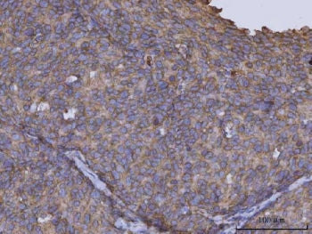 IHC staining of FFPE human cervical cancer tissue with ARL1 antibody. HIER: boil tissue sections in