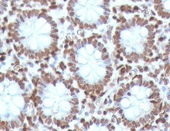 IHC testing of FFPE human colon carcinoma with CDX2 antibody (clone CTHP2-1). HIER: boil sections in