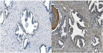 IHC staining of FFPE human prostate cancer with Cadherin 11 antibody. HIER: boil tissue sections in