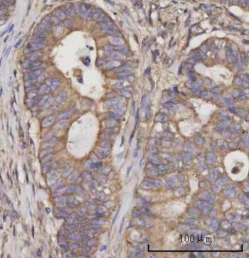 IHC staining of FFPE human rectum adenocarcinoma tissue with Selenocysteine lyase antibody. HIER: bo