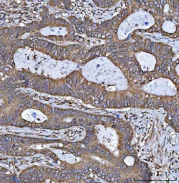 IHC staining of FFPE human colorectal adenocarcinoma tissue with 17HSD7 antibody. HIER: boil tissue