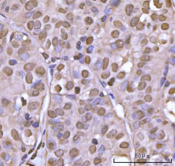 IHC staining of FFPE human thyroid papillary carcinoma tissue with NEIL3 antibody. HIER: boil tissue