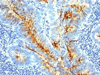 IHC: Formalin-fixed, paraffin-embedded human colon carcinoma stained with TAG-72 antibody (clone SPM