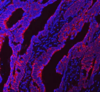Immunofluorescent staining of FFPE human colorectal adenocarcinoma tissue with NDUFS5 antibody (red)