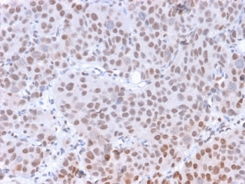 IHC staining of FFPE human colon carcinoma with phospho-RNA polymerase II antibody (clone CTD 8A7).