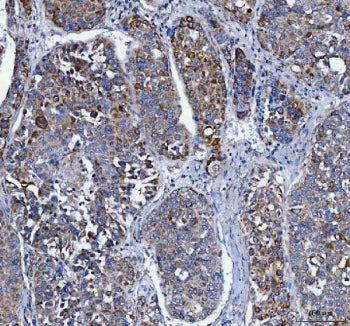 IHC staining of FFPE human liver cancer tissue with LRRC75B antibody. HIER: boil tissue sections in