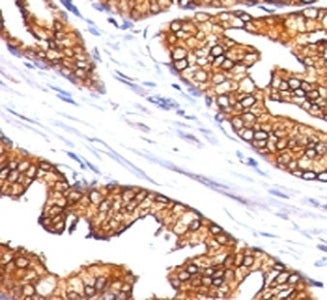 IHC: Formalin-fixed, paraffin-embedded human prostate carcinoma stained with ODC-1 antibody (clone S