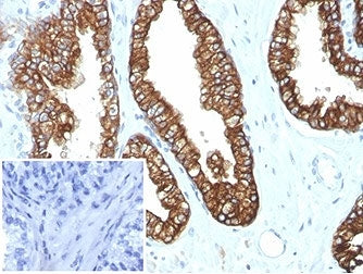 IHC staining of FFPE human prostate carcinoma tissue with recombinant Keratin 8/18 antibody (clone K