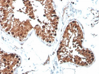 IHC staining of FFPE human testicular carcinoma with INHA antibody (clone R1). HIER: boil tissue sec
