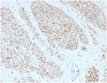IHC staining of FFPE human leiomyosarcoma with recombinant MYH11 antibody (clone MYH11/4337R). HIER: