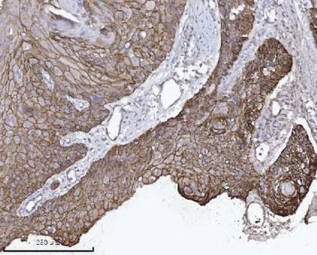 IHC staining of FFPE human laryngeal squamous cell carcinoma tissue with Catenin delta 1 antibody. H