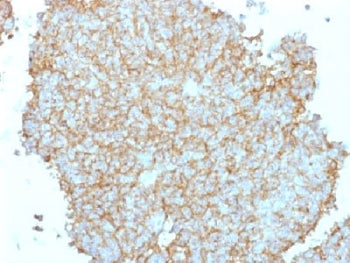 IHC testing of FFPE human Ewing's sarcoma with CD99 antibody. Required HIER: steam sections in 10mM