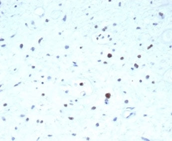 IHC staining of FFPE human rhabdomyosarcoma tissue with recombinant PAX7 antibody (clone PAX7/7079R)