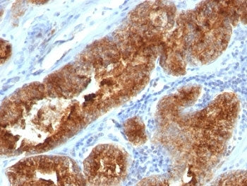 IHC: Formalin-fixed, paraffin-embedded human prostate carcinoma stained with TAG-72 antibody (B72.3