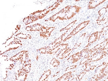 IHC staining of FFPE human colon carcinoma with MLH1 antibody (clone G168-728). HIER: boil tissue se