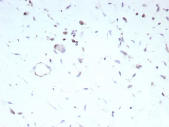 IHC staining of FFPE human rhabdomyosarcoma tissue with recombinant Myoblast determination protein 1
