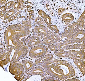 IHC staining of FFPE human rectal cancer tissue with FKBP1A/B antibody. HIER: boil tissue sections i