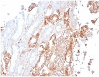 IHC staining of FFPE human renal cell carcinoma tissue with Alpha Fodrin antibody (clone SPTAN1/3506