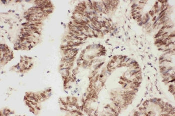 IHC staining of FFPE human rectal cancer with ALK antibody. HIER: boil tissue sections in pH6 citrat