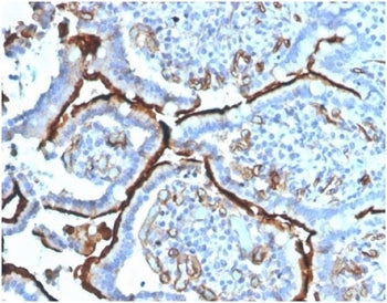 IHC staining of FFPE human colon carcinoma tissue with Angiotensin Converting Enzyme antibody (clone
