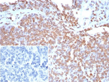 IHC staining of FFPE human ovarian cancer tissue with Double Stranded DNA antibody (clone rDSD/8266)