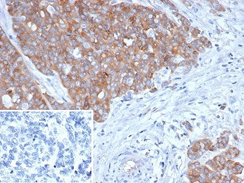 IHC staining of FFPE human ovarian cancer tissue with BRAF antibody (clone BRAF/1626). Inset: PBS us
