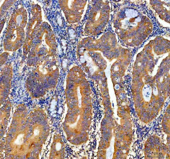 IHC staining of FFPE human colon cancer tissue with NQO1 antibody, HRP-secondary and DAB substrate.