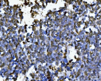 IHC staining of FFPE human lung cancer tissue with SUB1 antibody. HIER: boil tissue sections in pH8