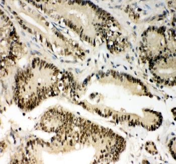 IHC staining of FFPE human colon cancer tissue with PIN1 antibody, HRP-secondary and DAB substrate.