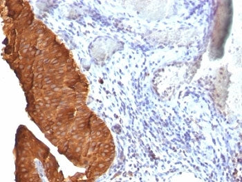 IHC: Formalin-fixed, paraffin-embedded human bladder carcinoma stained with Cytokeratin 19 antibody