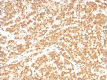 IHC staining of FFPE human colon carcinoma with ICOS Ligand antibody (clone ICOSL/3260). HIER: boil
