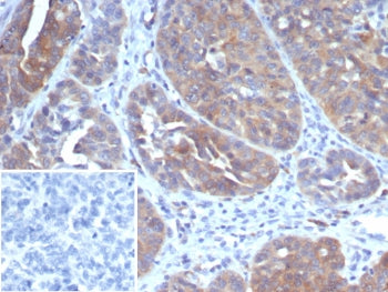 IHC staining of FFPE human ovarian cancer tissue with GLCLR antibody (clone GCLM/4069). Inset: PBS u