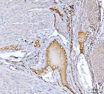 IHC staining of FFPE human endometrial cancer tissue with Clusterin antibody. HIER: boil tissue sect